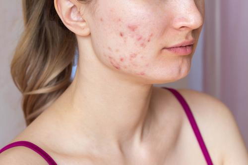 Young-woman-infected-with-Acne-in-face-and-jawline.