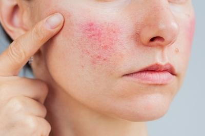 Woman with rosacea on face