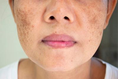 Age spot on woman's face