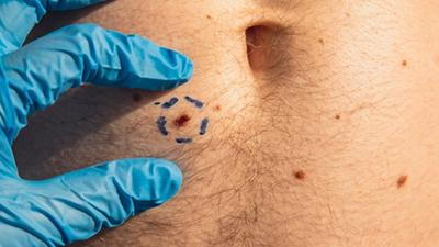 Skin doctor preparing for mole removal procedure after marking treatment area