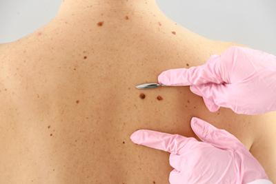 Illustration of how mole removal procedure on clinic
