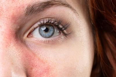 Illustration of Rosacea on womans face with redness