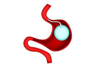 3d illustration of gastric ballon
