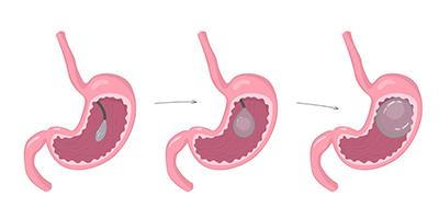 Stomach anatomy with inserted gastric balloon for non-surgical weight loss