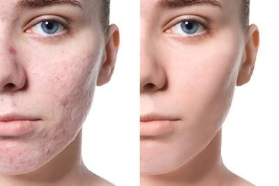 Acne scar reduction results shown pre- and post-laser therapy