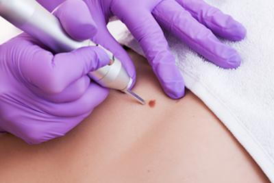 Procedure of removing the mole on patient skin