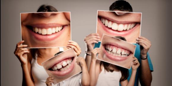 Aluminum Foil Teeth Whitening And Diy Hacks That Harm Teeth