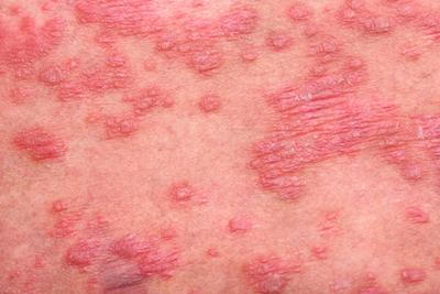 Flaky and inflamed skin from psoriasis