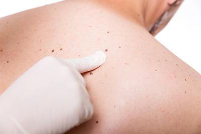 Dermatologist pointing out the mole in the back of patient