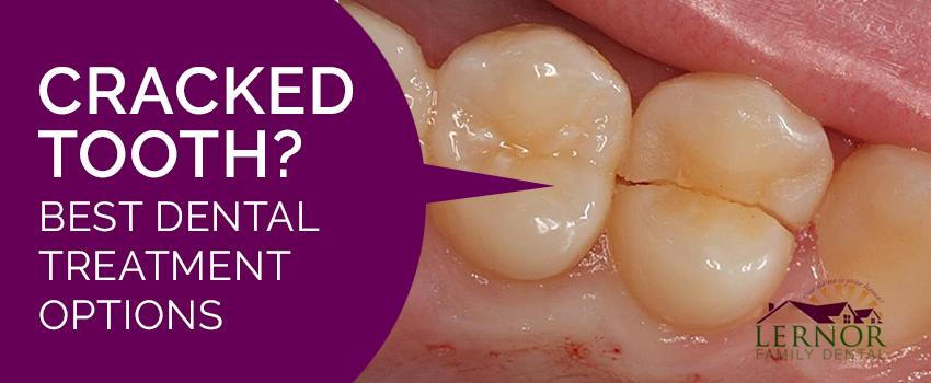 Cracked tooth - causes and treatment methods