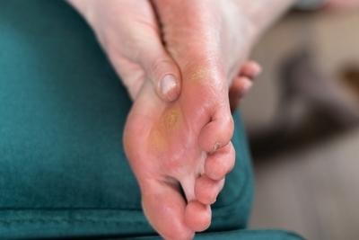 Person with foot callus under foot holding it.
