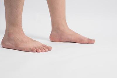 Person with flat feet condition with white background.