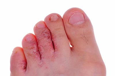 Illustration of Athlete’s Foot on persons foot