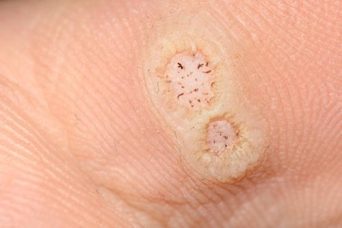 Close-up of a foot sole affected by plantar warts.