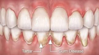 Teeth Gums