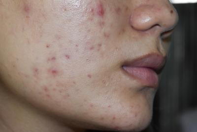 Acne and pimples on a woman's cheek and jawline