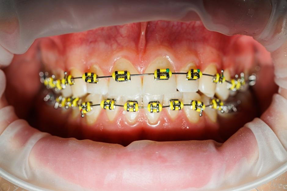 Why Do Orthodontists Prescribe Braces for Impacted Teeth?