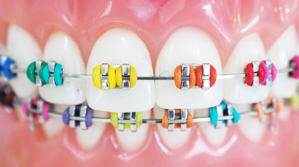 Braces bracket deals colors