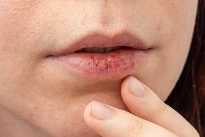 Close-up of dry cracked lips showing skin reaction to winter weather