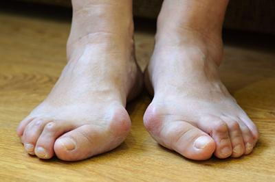 Illustration of bunions condition on patient foot