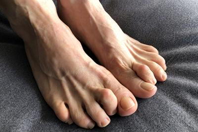 Hammertoes condition on a persons feet