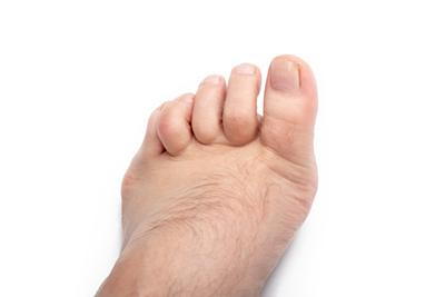 Illustration of Hammertoes condition