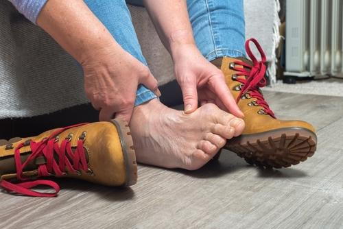 Close-up of a woman's foot showing hammertoe deformity caused by wearing narrow shoes.