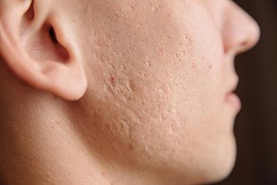 Man-with-Acne-Scars