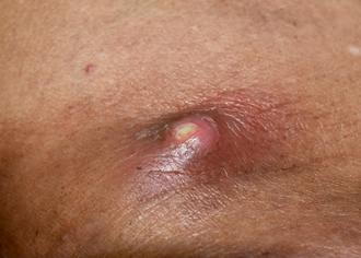 Ingrown hair and staph infection Symptoms causes treatment