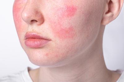 Red Spots on Skin - Causes and Treatment