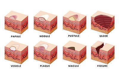 Types-of-Skin-Lesions