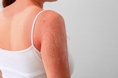 Woman suffering from sun burn on arms