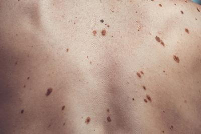 Melanoma skin condition on a patients skin
