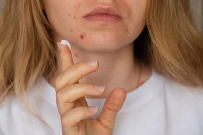 Acne in face of woman with some cream if her fingers'