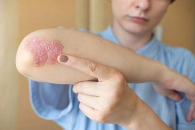 Illustration of Psoriasis on arm and skin of patient