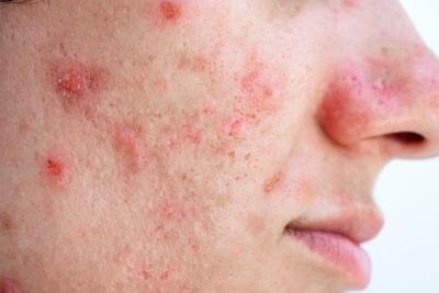 Illustration of acne on persons face