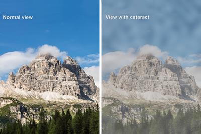 Difference-of-Normal-Eye-and-Eye-with-Cataract