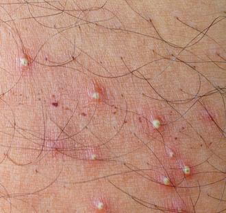What Are Hair Follicle Infections?