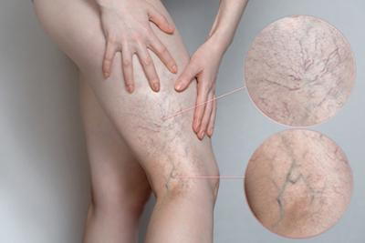 Illustration of Varicose Veins on persons legs