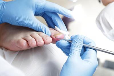 Ingrown Toenails: Causes, Treatment, and Prevention