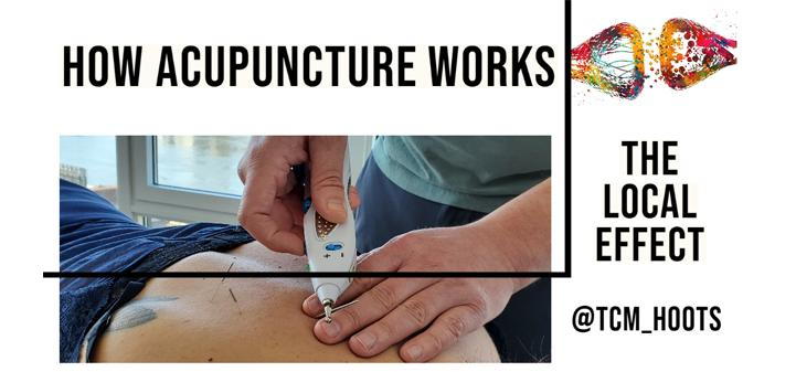 Electro-acupuncture for back pain