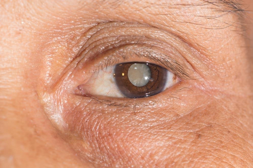 how quickly do cataracts develop