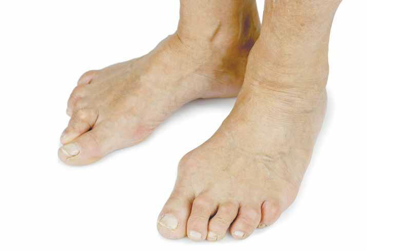 High Arch Feet (Cavus Foot): What Is It, Symptoms, Causes & Treatment
