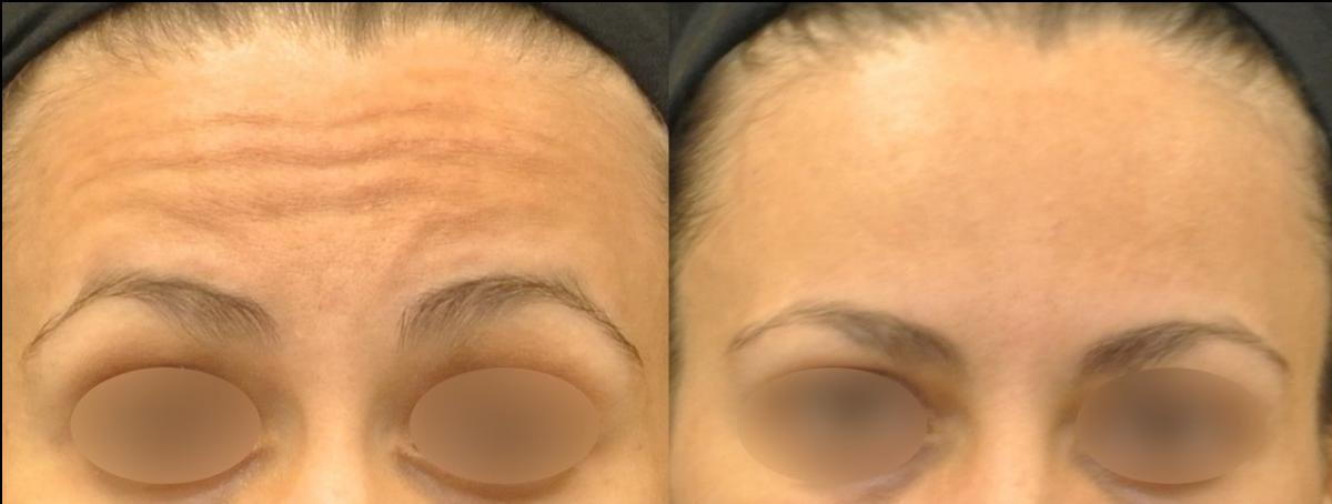 Botox for Horizontal Forehead Lines