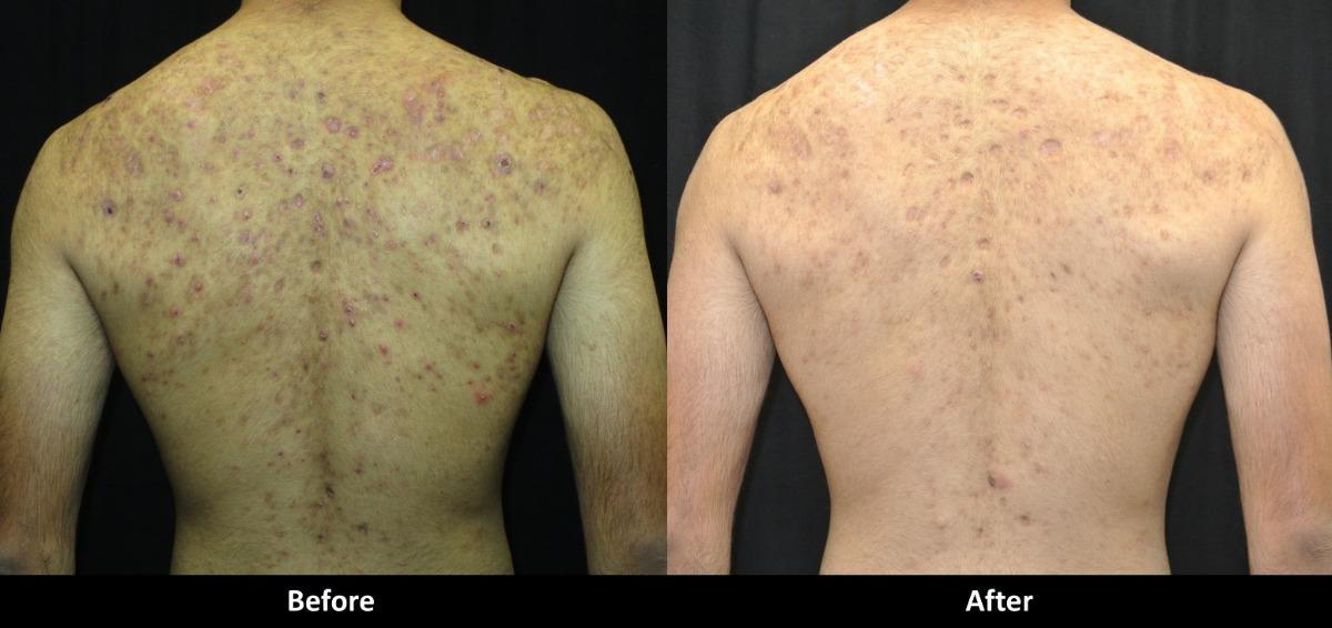 back acne scars