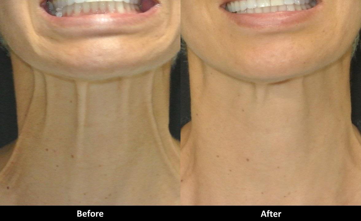 Botox Can Treat Your Vertical Neck Bands 