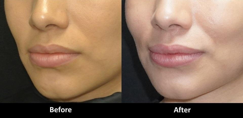 How to Get the Lips You Want: Natural Lip Enhancement