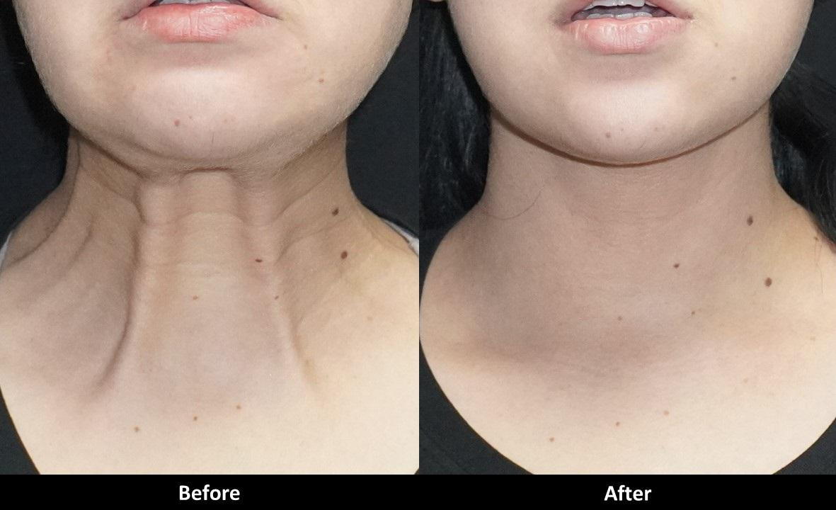 Botox can treat wrinkles and bands on the neck