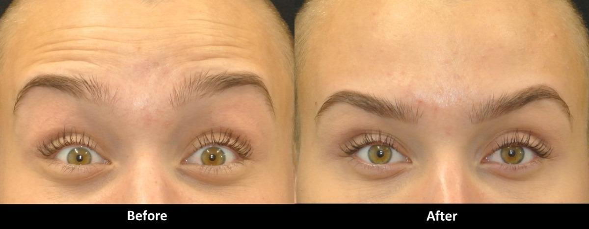 Can You Fix A Droopy Brow From Botox