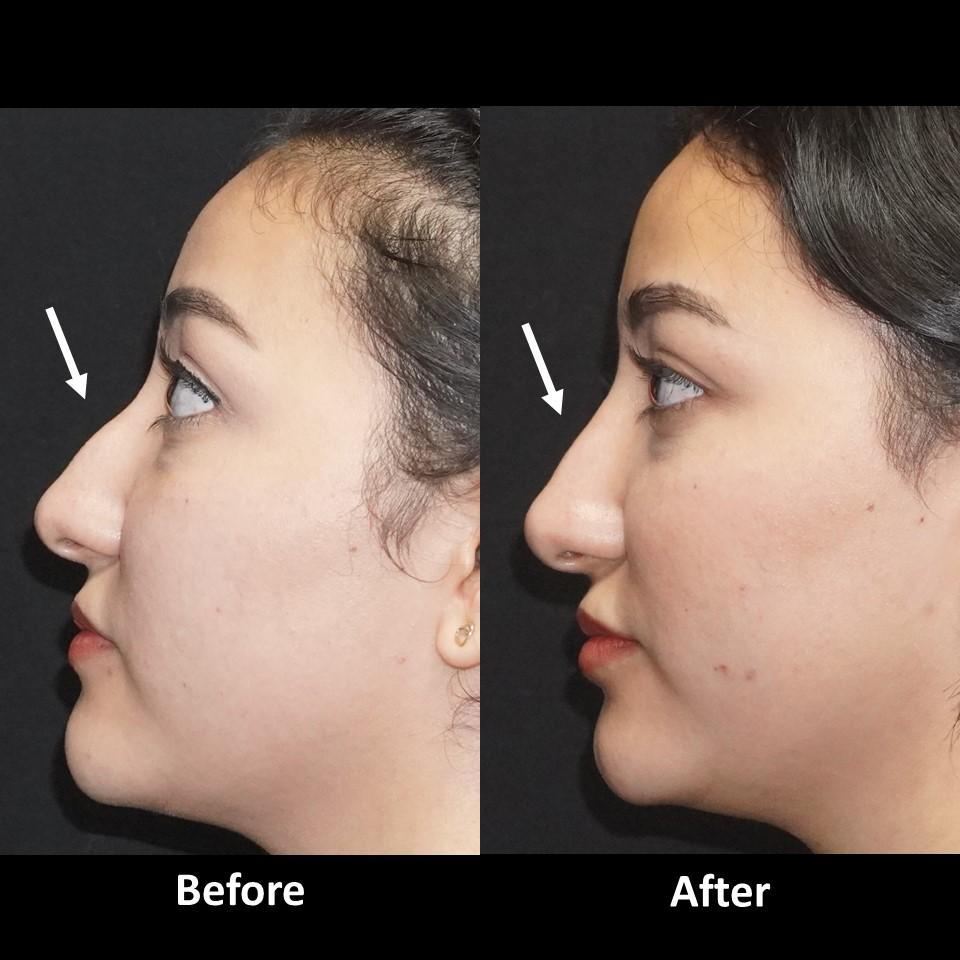 non surgical nose lift before and after